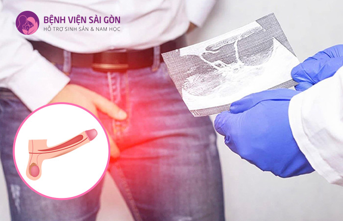 Rối loạn cương là mất khả năng duy trì sự cương cứng để thỏa mãn tình dục