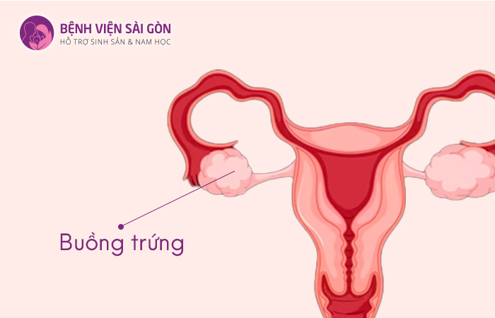 Buồng trứng xuất hiện khối u nang buồng trứng chứa chất dịch hoặc chất rắn giống như bã đậu