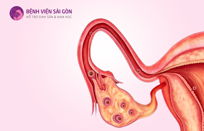 Các u nang buồng trứng có thể phát triển đạt đến kích thước 8cm