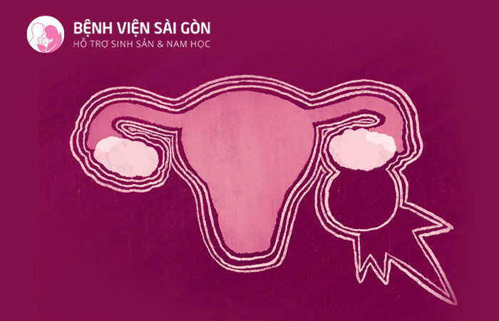 U nang buồng trứng nếu không kiềm hãm sự phát triển chúng có thể vỡ và gây nguy hiểm đến tính mạng