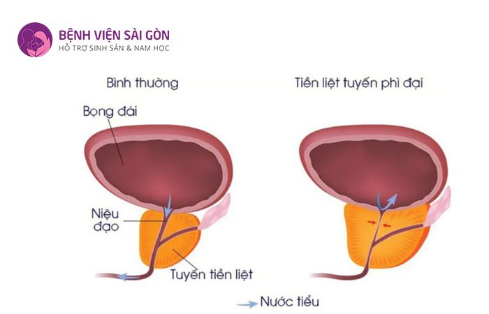 Phì đại tuyến tiền liệt là nguyên nhân gây ra tình trạng xuất tinh ngược