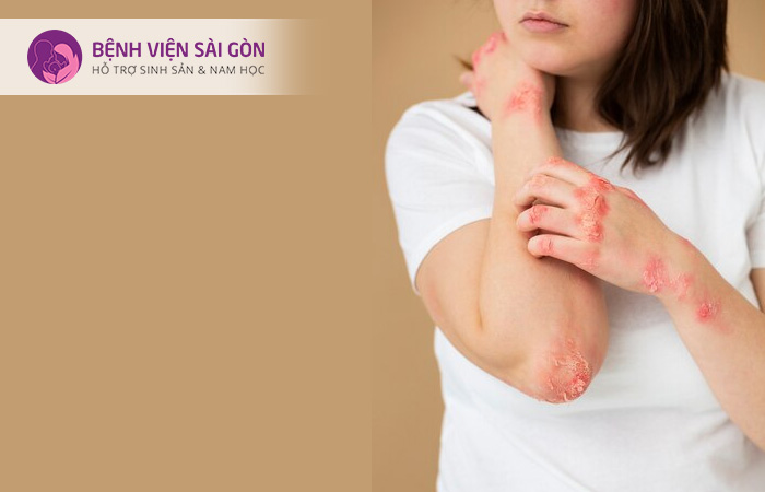 Phụ nữ mắc lupus ban đỏ dễ bị tiền sản giật nếu mang thai