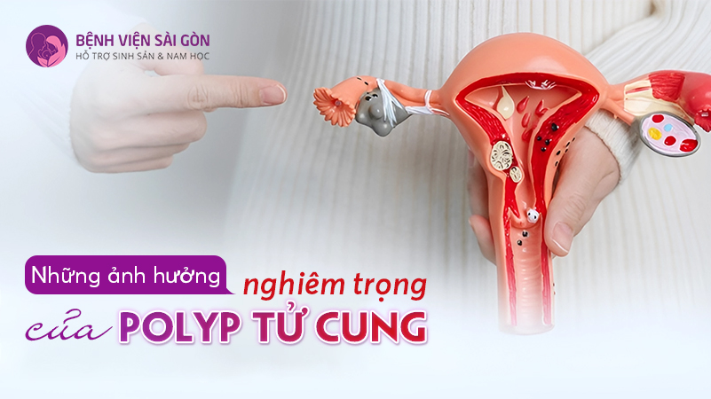 Polyp tử cung ảnh hưởng như thế nào đến sức khỏe của nữ giới