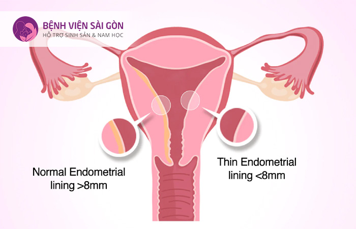 Độ dày lớp niêm mạc tử cung thay đổi khi đến chu kỳ kinh nguyệt