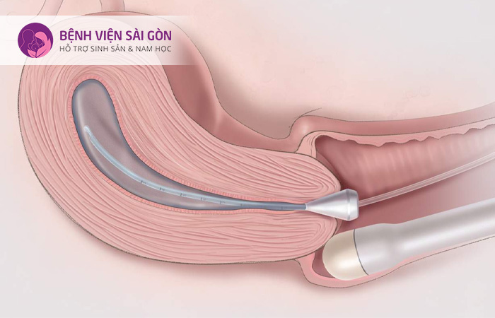 Siêu âm qua ngã âm đao để phát hiện polyp tử cung