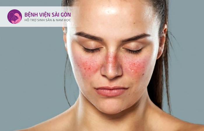 Lupus ban đỏ là nguyên nhân khiến niêm mạc tử cung bị tổn thương