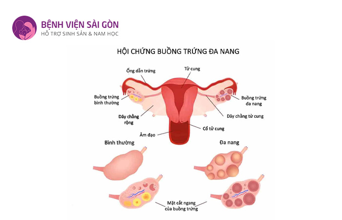 PCOS phù hợp cho người bị đa nang buồng trứng