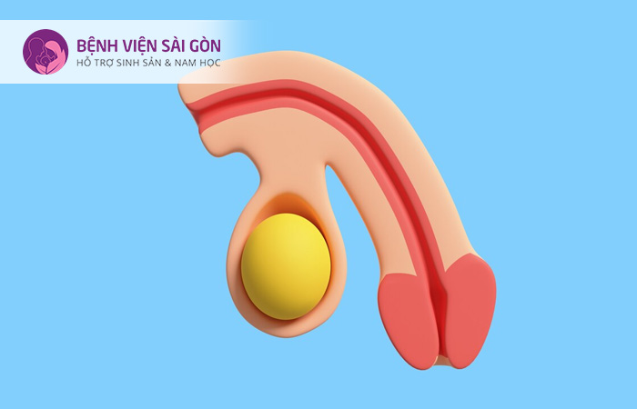 Thay đổi trên da của dương vật thường là dấu hiệu phổ biến nhất của ung thư dương vật