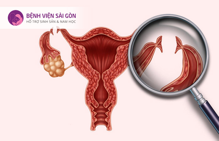 Cắt vòi trứng là phương pháp được chỉ định trong điều trị tắc vòi trứng