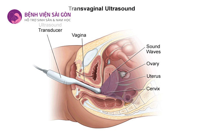 Siêu âm đầu dò dùng để xác định tình trạng ứ mủ hoặc ứ nước vòi trứng