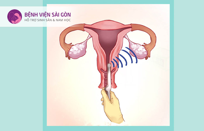 Hạn chế thực hiện siêu âm đầu dò khi nữ giới đến kỳ kinh
