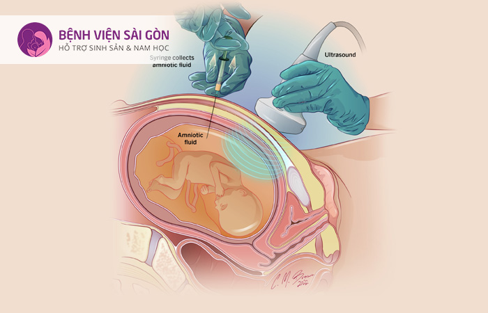 Chọc ối là một thủ thuật thường được tiến hành vào tuần thứ 15 - 18 của thai kỳ