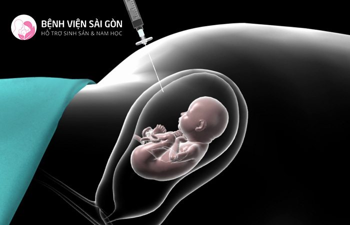 Chọc ối giúp xác định thai nhi có nguy cơ mắc các rối loạn di truyền hoặc bất thường nhiễm sắc thể không