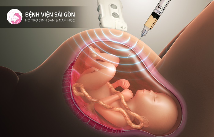 Chọc ối được chỉ định cho những mẹ bầu có nguy cơ mắc rối loạn di truyền