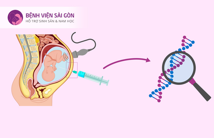 Chọc ối lfa phương pháp xâm lấn nên mẹ bầu cần lưu ý khi thực hiện Chọc ối lfa phương pháp xâm lấn nên mẹ bầu cần lưu ý khi thực hiện