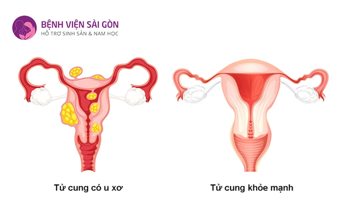 Người mắc bệnh u xơ tử cung, buồng trứng sẽ ảnh hưởng tỷ lệ thành công IVF