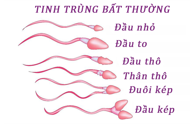 Vô sinh do yếu tố nam giới